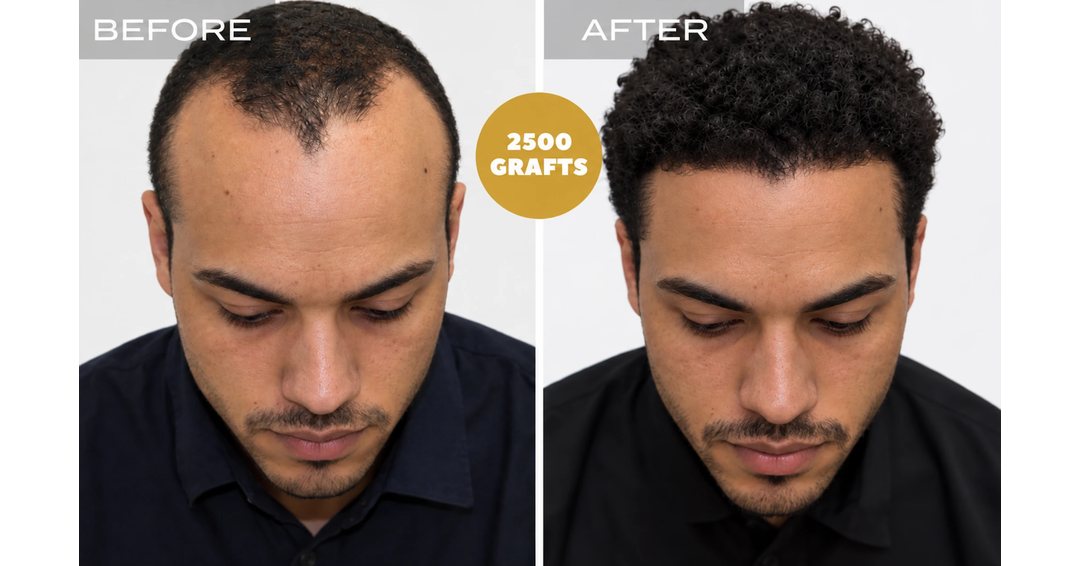 Curly hair hairline and density restoration with 2,500 FUE grafts - hair transplant before and after at Nova Medical Boston