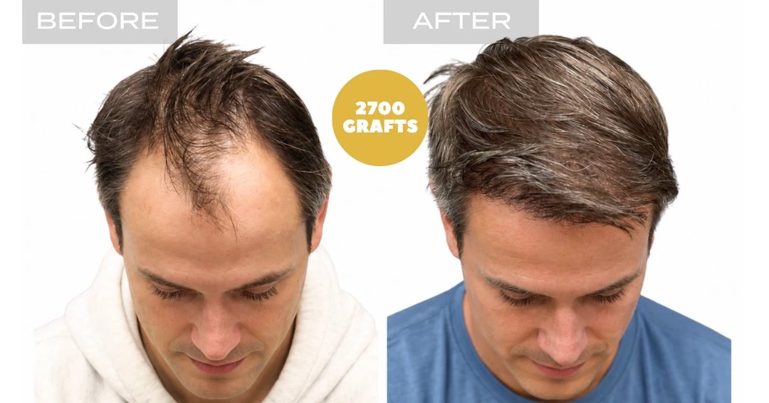 Receding hairline and frontal density restoration with 2,700 FUE grafts - hair transplant before and after at Nova Medical Boston