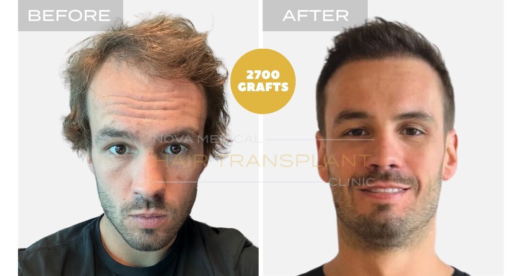 Hair Transplant Before & After Result 1 - HAIRLINE + DENSITY RESTORATION. MANUAL FUE 2700 GRAFTS., Nova Medical