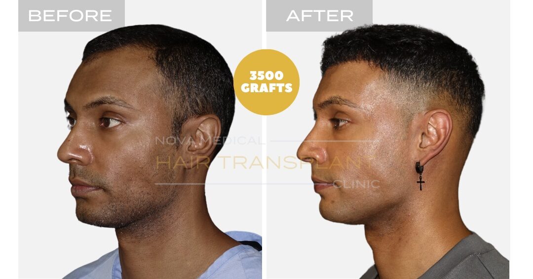 Hair Transplant Before & After Result 3 - THICK HAIR HAIRLINE RESTORATION. MANUAL FUE 3500 GRAFTS., Nova Medical