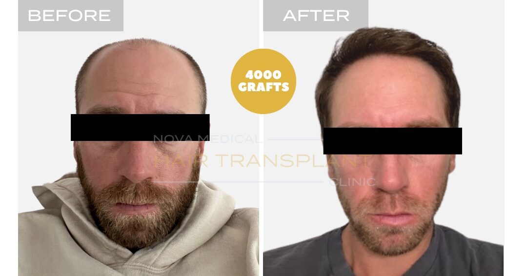 Hair Transplant Before & After Result 5 - HAIRLINE FORMATION + CROWN DENSITY RESTORATION. MANUAL FUE 4000 GRAFTS + DHI., Nova Medical
