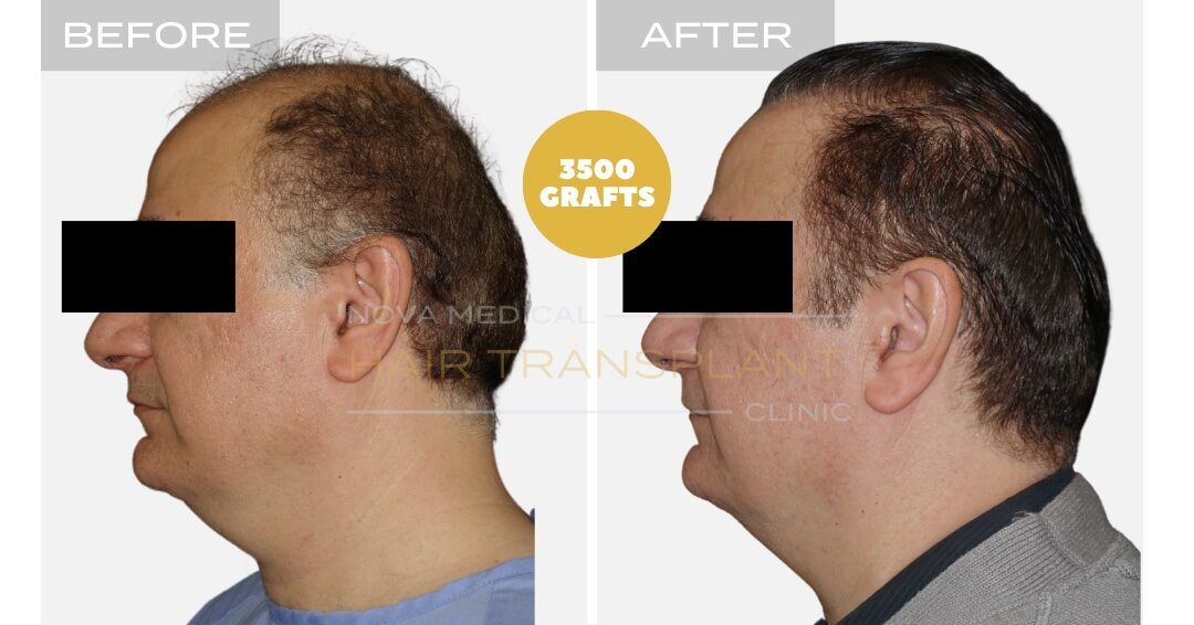 Hair Transplant Before & After Result 8 - HAIRLINE FORMATION + CROWN DENSITY RESTORATION. MANUAL FUE 3500 GRAFTS., Nova Medical