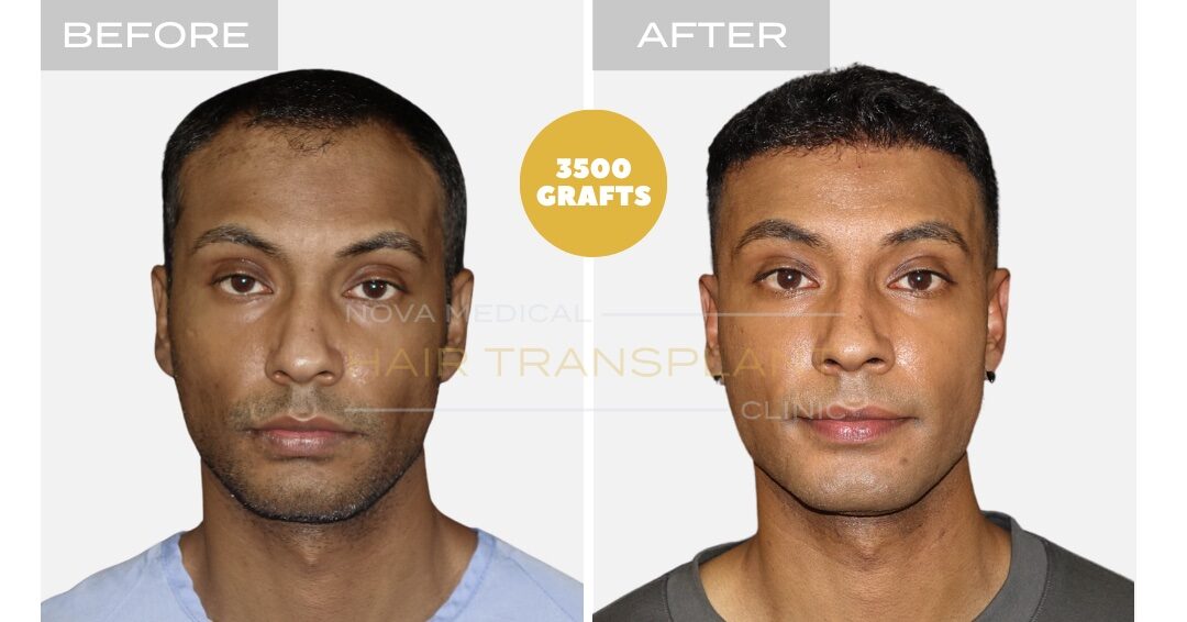 Hair Transplant Before & After Result 9 - THICK HAIR HAIRLINE RESTORATION. MANUAL FUE 3500 GRAFTS., Nova Medical