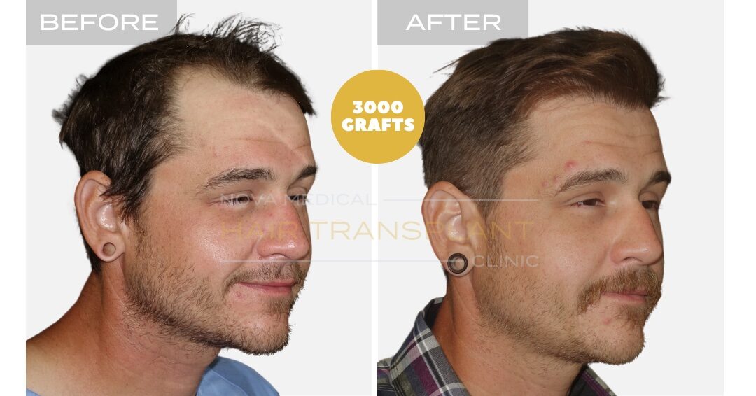 Hair Transplant Before & After Result 11 - HIGH DENSITY HAIRLINE RESTORATION. MANUAL FUE 3000 GRAFTS., Nova Medical