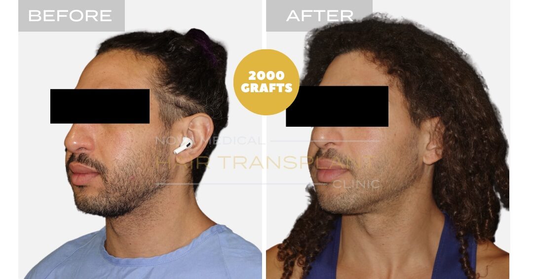 Hair Transplant Before & After Result 12 - NON-SHAVE CURLY HAIRLINE RESTORATION. MANUAL FUE 2000 GRAFTS., Nova Medical