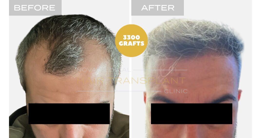 Hair Transplant Before & After Result 14 - HAIRLINE + FRONTAL DENSITY RESTORATION. MANUAL FUE 3000 GRAFTS., Nova Medical