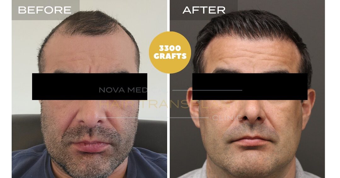 Hair Transplant Before & After Result 16 - HAIRLINE + FRONTAL DENSITY RESTORATION. MANUAL FUE + DHI 3300 GRAFTS., Nova Medical