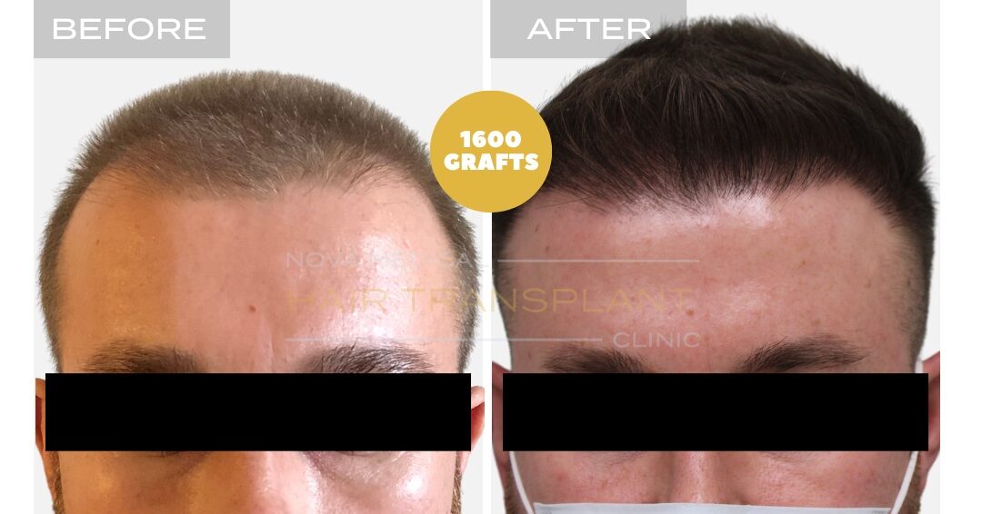 Hair Transplant Before & After Result 18 - HAIRLINE RESTORATION TOUCHUP. MANUAL FUE 1600 GRAFTS., Nova Medical