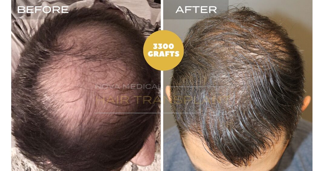 Hair Transplant Before & After Result 19 - CROWN + HAIRLINE RESTORATION. MANUAL FUE 3300 GRAFTS., Nova Medical