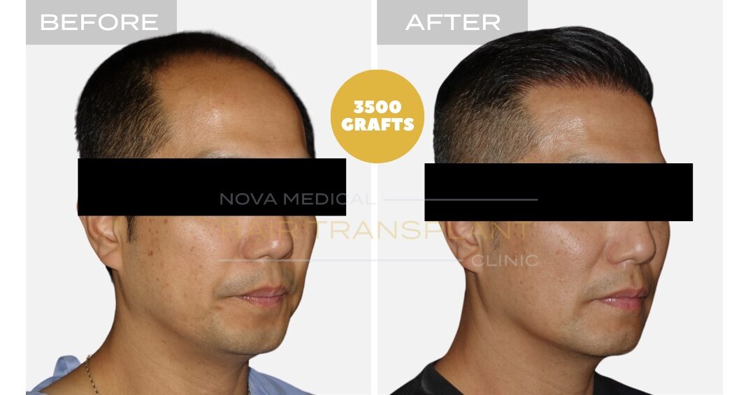 Hair Transplant Before & After Result 20 - HIGH DENSITY HAIRLINE RESTORATION. ASIAN HAIR MANUAL FUE 3500 GRAFTS., Nova Medical