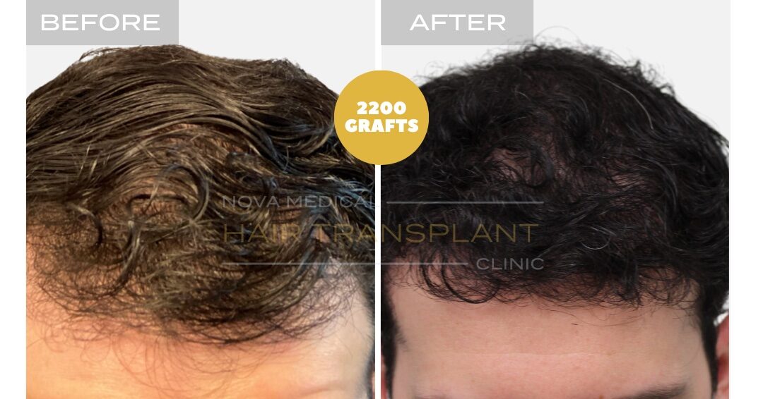 Hair Transplant Before & After Result 21 - HAIRLINE + DENSITY RESTORATION. MANUAL FUE 2200 GRAFTS., Nova Medical