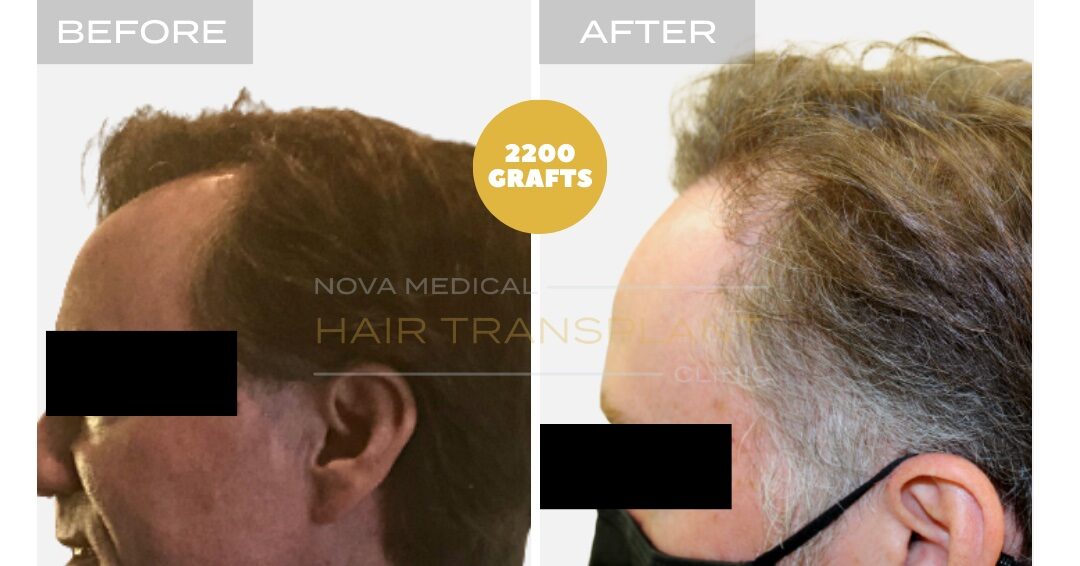 Hair Transplant Before & After Result 22 - TEMPLE FILLING + HAIRLINE RESTORATION. MANUAL FUE 2200 GRAFTS., Nova Medical