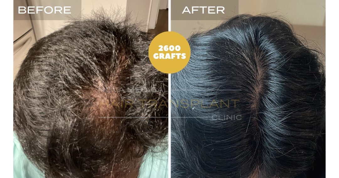 Hair Transplant Before & After Result 23 - CROWN DENSITY RESTORATION. MANUAL FUE 2600 GRAFTS., Nova Medical