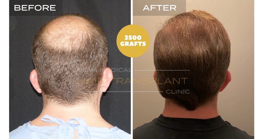 Hair Transplant Before & After Result 24 - CROWN DENSITY RESTORATION. MANUAL FUE 3500 GRAFTS., Nova Medical