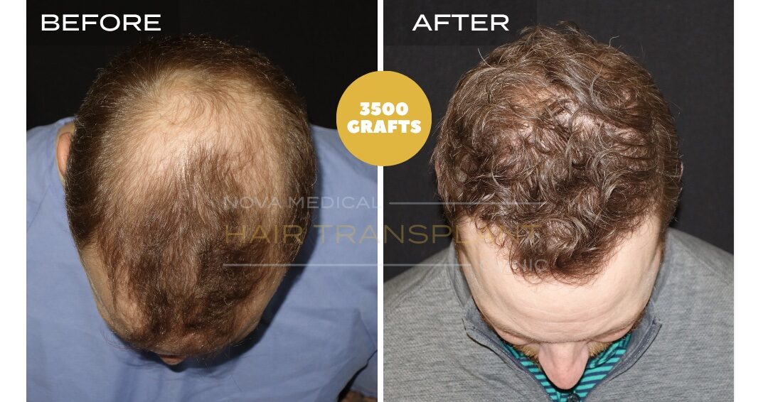 Hair Transplant Before & After Result 25 - CROWN + HAIRLINE RESTORATION. MANUAL FUE 3500 GRAFTS., Nova Medical
