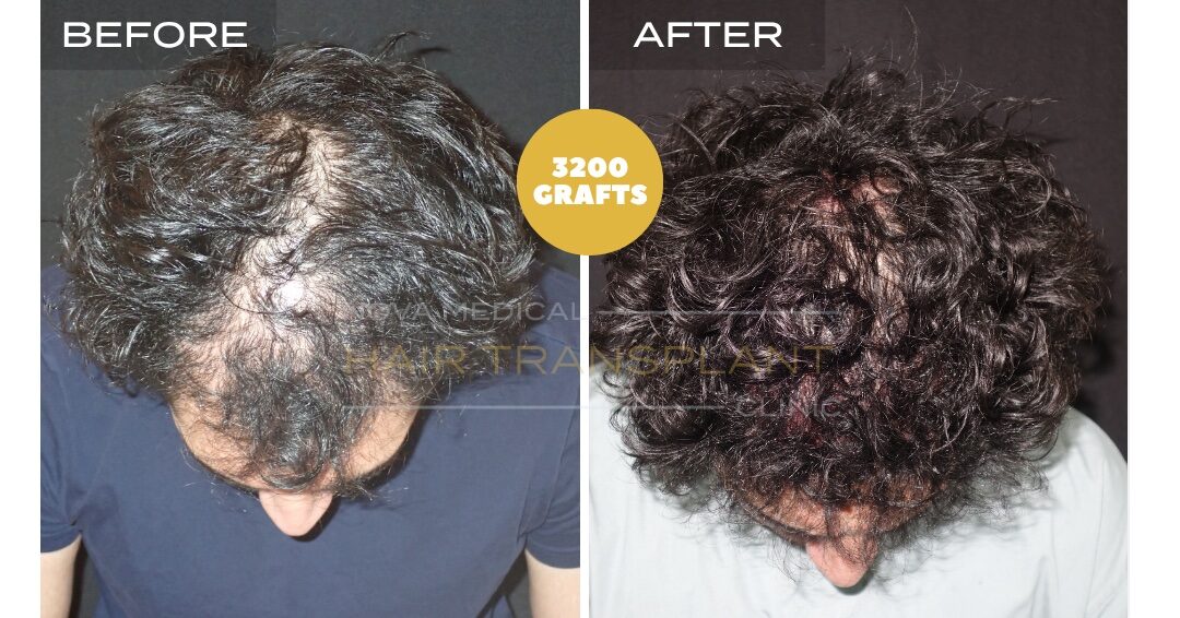 Hair Transplant Before & After Result 26 - DENSITY RESTORATION. MICRO FUE 3200 GRAFTS., Nova Medical