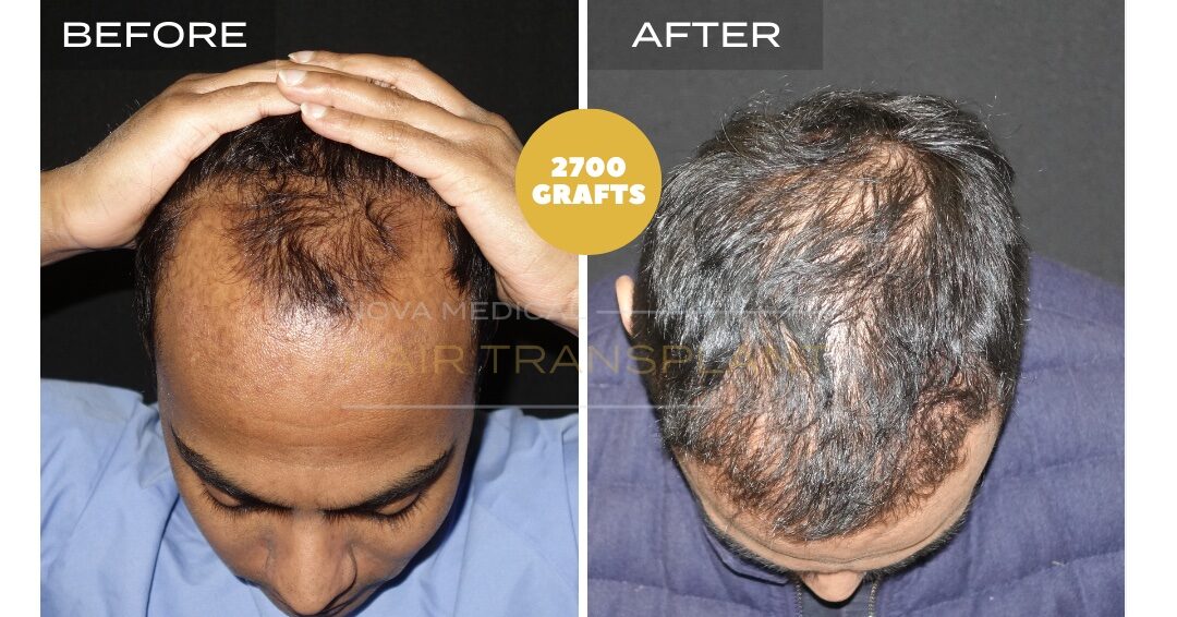 Hair Transplant Before & After Result 28 - HAIRLINE + DENSITY RESTORATION. MANUAL FUE 2700 GRAFTS., Nova Medical