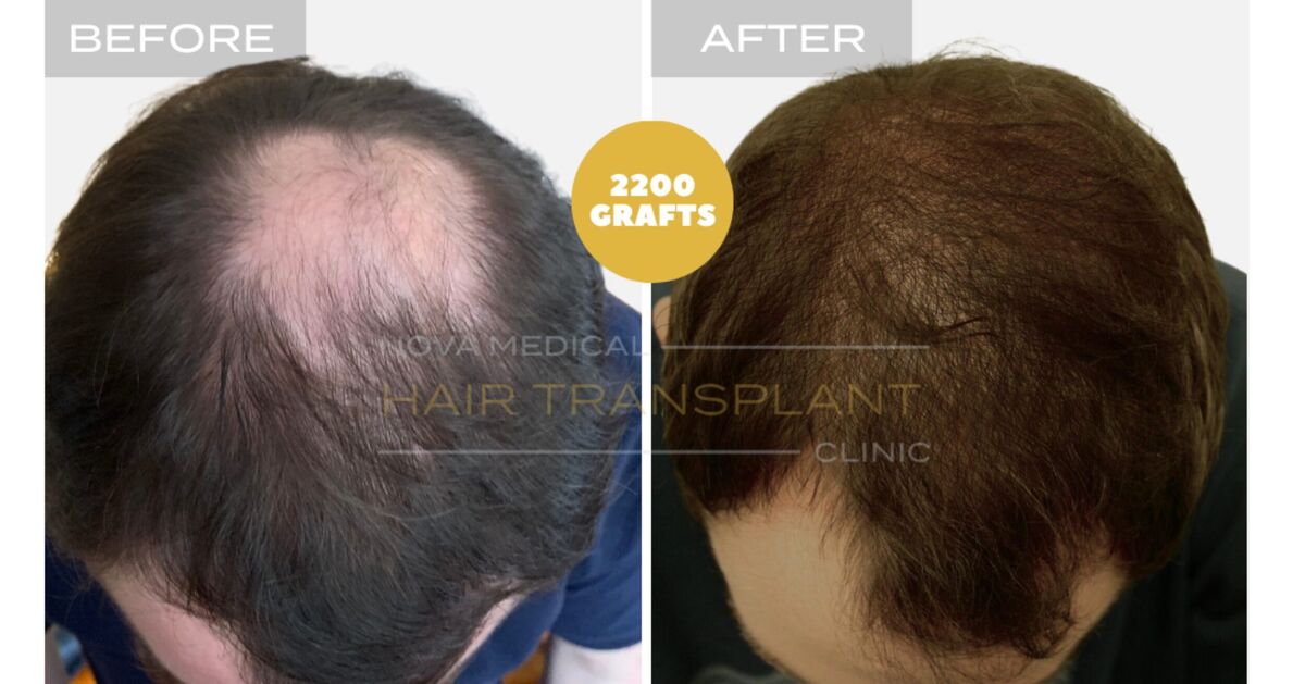 Hair Transplant Video Case Study 2 - CROWN FILLING. MANUAL FUE 2200 GRAFTS + DHI., Nova Medical