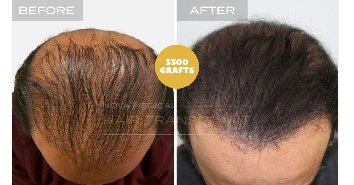 Hair Transplant Video Case Study 3 - LIMITED DONOR AREA. FIXING FACE TO FACE APPEARANCE + DENSITY FILLING, Nova Medical