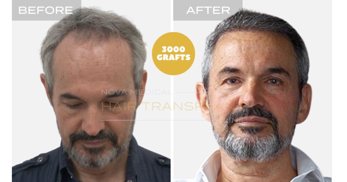 Hair Transplant Video Case Study 4 - HAIRLINE RESTORATION + DENSITY FILLING. MANUAL FUE 3000 GRAFTS., Nova Medical