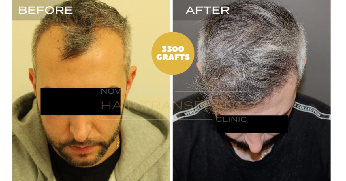 Hair Transplant Video Case Study 5 - HAIRLINE RESTORATION DENSITY FILLING. MANUAL FUE 3300 GRAFTS., Nova Medical