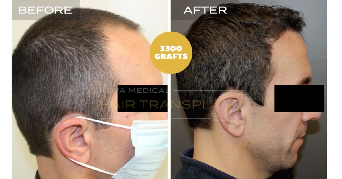 Hair Transplant Video Case Study 7 - TEMPLE FILLING + HAIRLINE RESTORATION. MANUAL FUE 3300 GRAFTS., Nova Medical