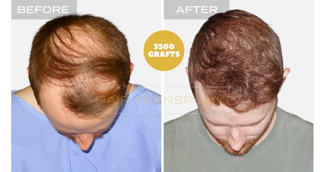 Hair Transplant Before and After - Patient 2, Nova Medical