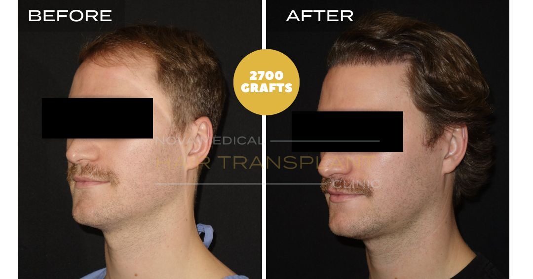 Hair Transplant Before and After - Patient 5 angle 2, Nova Medical