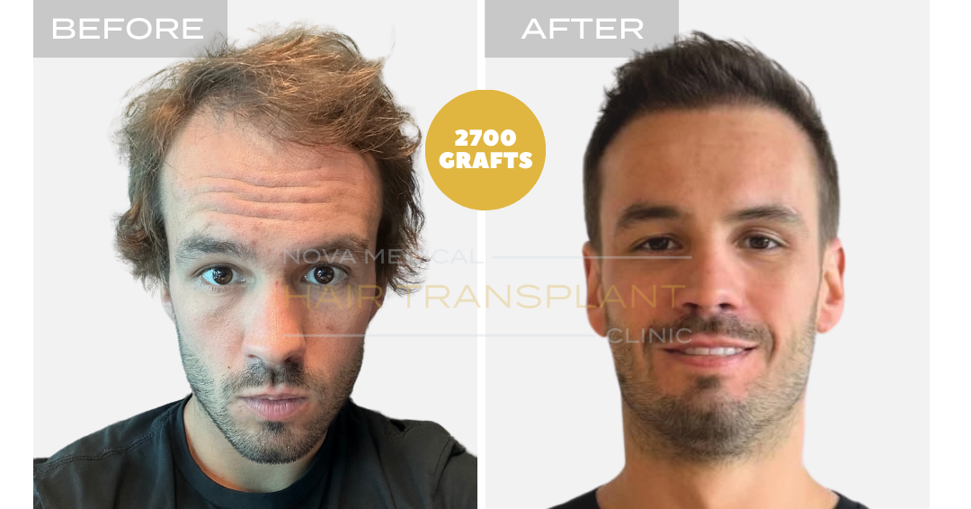 Hair transplant before and after result