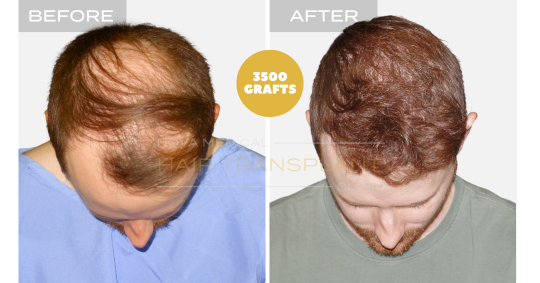 Hair transplant patient result