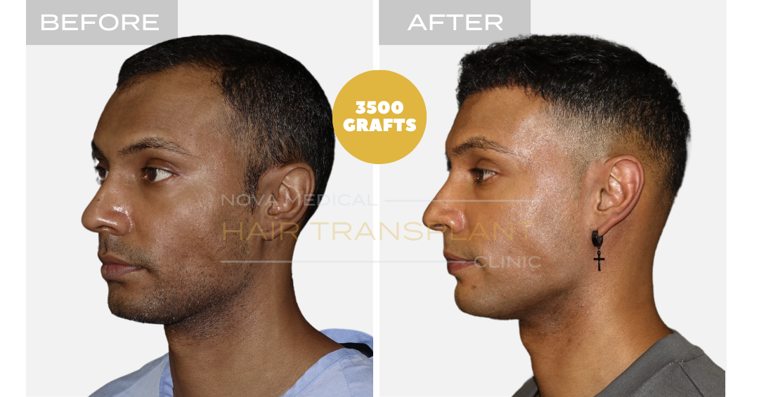 Hair transplant transformation result