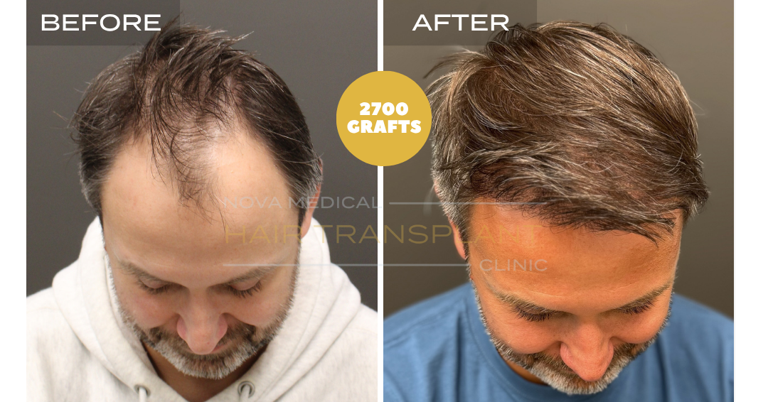 Hair transplant before and after