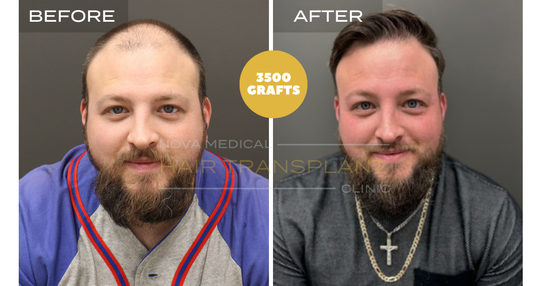 Hair transplant before and after